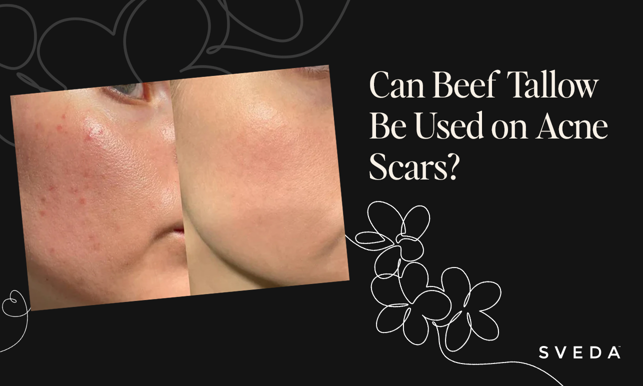 Can Beef Tallow Be Used on Acne Scars?