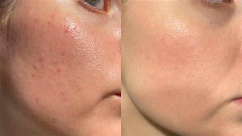 Does Beef Tallow Get Rid of Acne Scars?