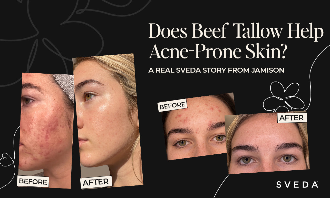 Jamison sharing her experience using SVEDA grass-fed beef tallow skincare for acne-prone skin